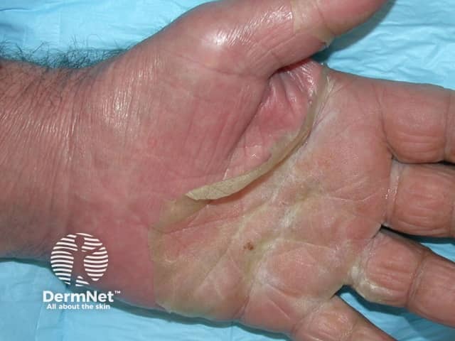 agep image from DermNet