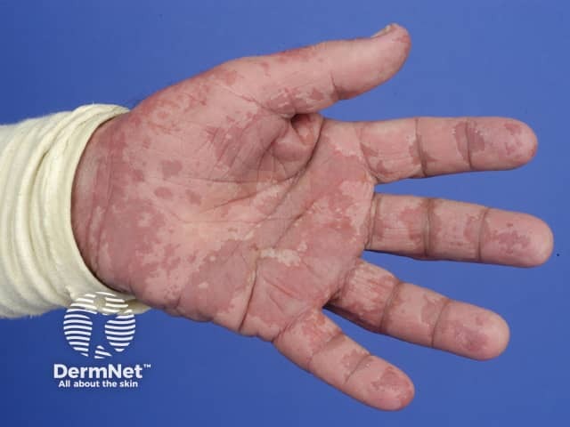 agep image from DermNet