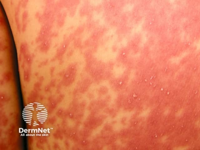 agep image from DermNet