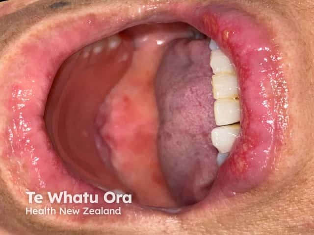 agep image from DermNet