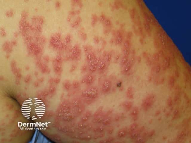 agep image from DermNet