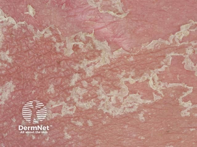 agep image from DermNet