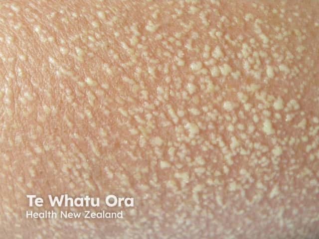 agep image from DermNet