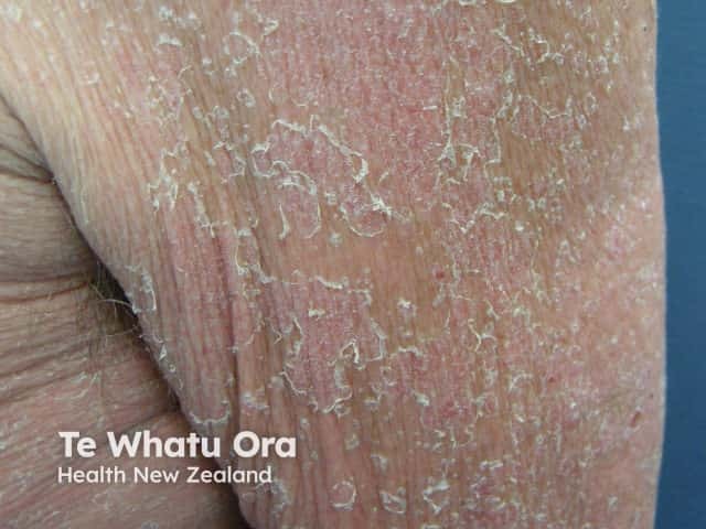 agep image from DermNet