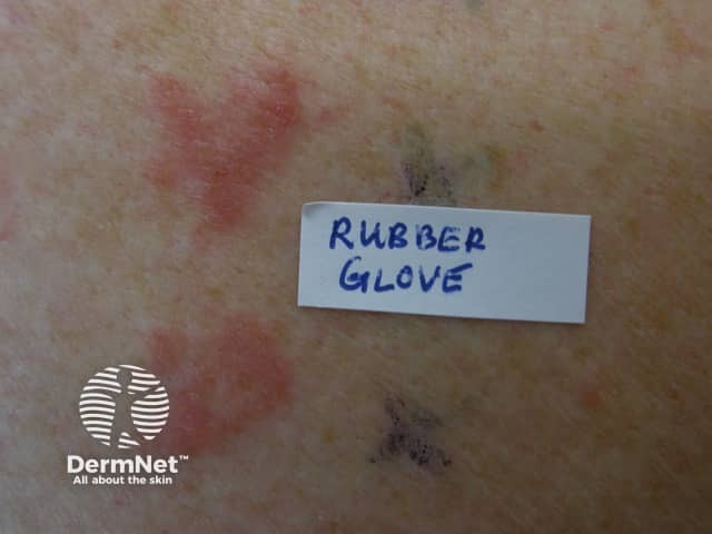 A positive patch test to a piece of a suspect rubber glove 48 hrs after application on the skin