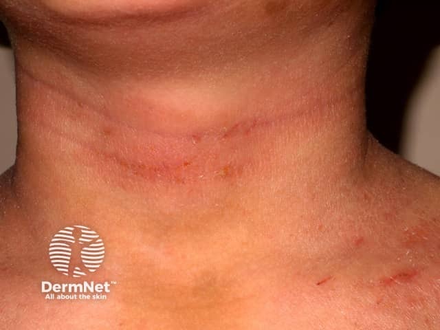 atopic-dermatitis image from DermNet