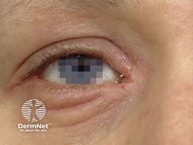 atopic-dermatitis image from DermNet