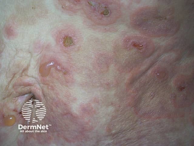 bullous-pemphigoid image from DermNet