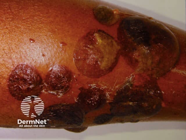 bullous-pemphigoid image from DermNet