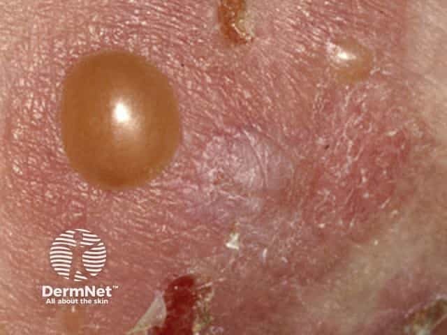 bullous-pemphigoid image from DermNet