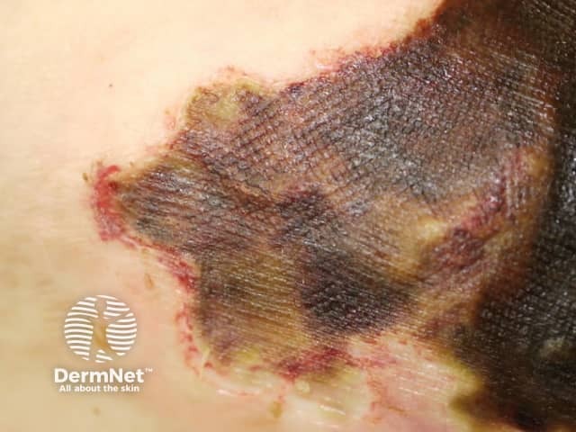 calciphylaxis image from DermNet
