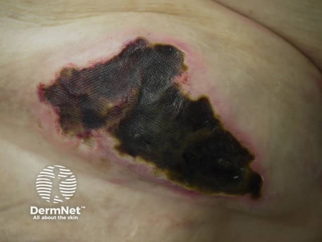 calciphylaxis image from DermNet