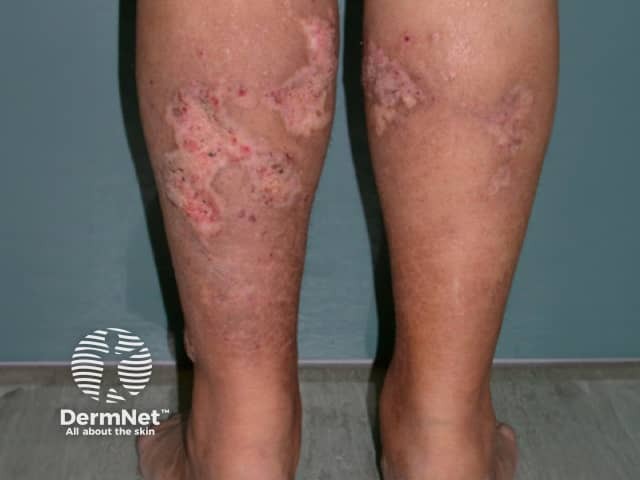 calciphylaxis image from DermNet