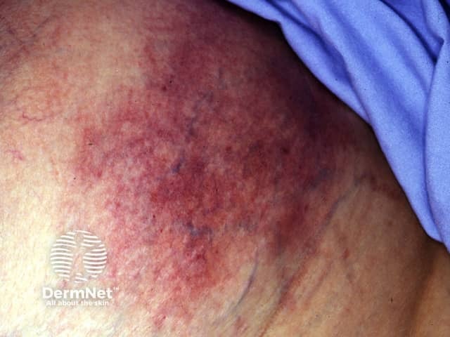 calciphylaxis image from DermNet