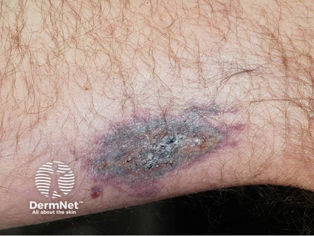 calciphylaxis image from DermNet