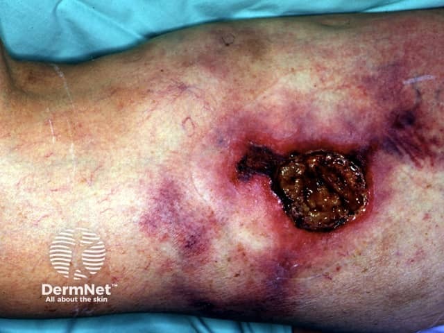 calciphylaxis image from DermNet