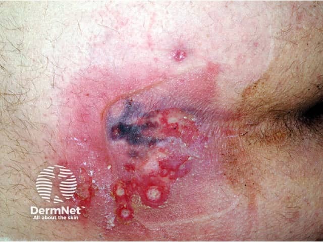 calciphylaxis image from DermNet