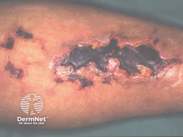 calciphylaxis image from DermNet
