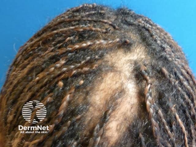 ccca image from DermNet