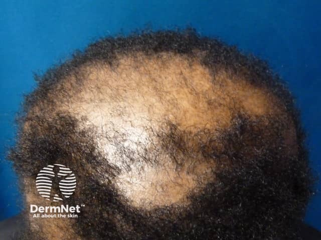 ccca image from DermNet