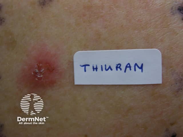 Allergic contact dermatitis to rubber