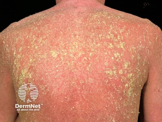 erythroderma image from DermNet