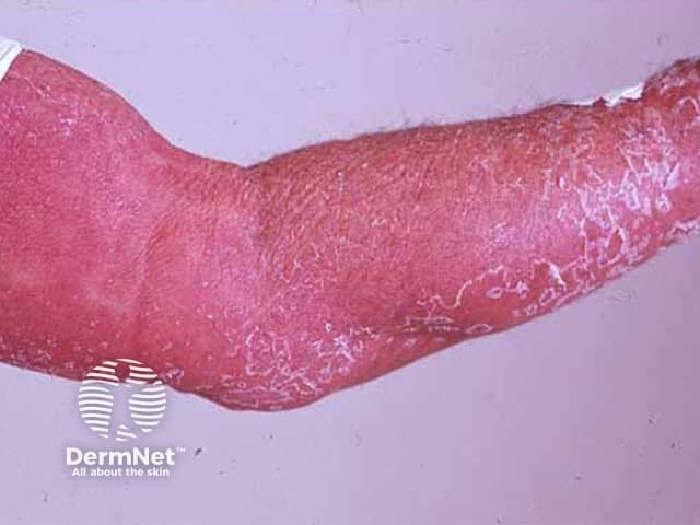 erythroderma image from DermNet