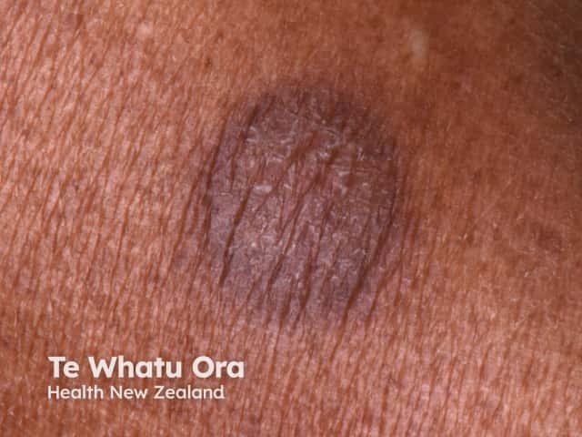 fixed-drug-eruption image from DermNet