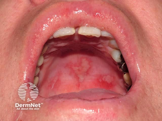 Ulcerated fixed drug eruption, oral mucosa