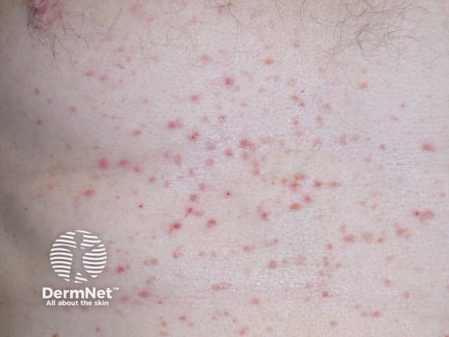 grovers-disease image from DermNet