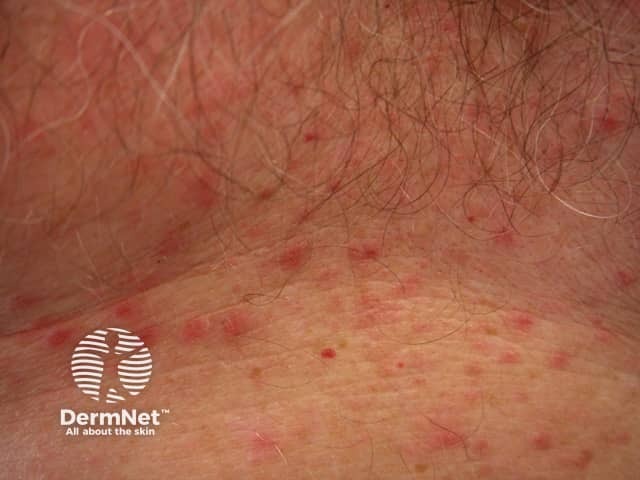 grovers-disease image from DermNet