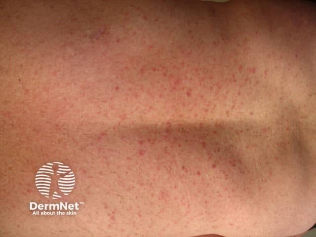 grovers-disease image from DermNet