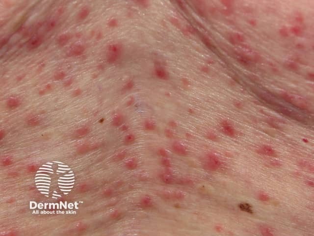 grovers-disease image from DermNet