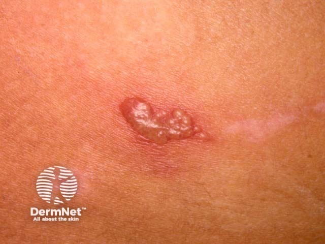 herpes-simplex image from DermNet