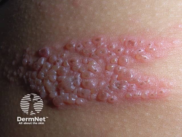 herpes-zoster image from DermNet
