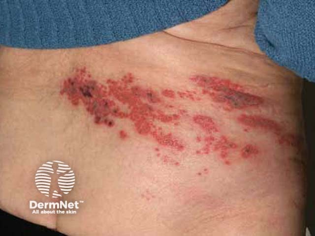 herpes-zoster image from DermNet