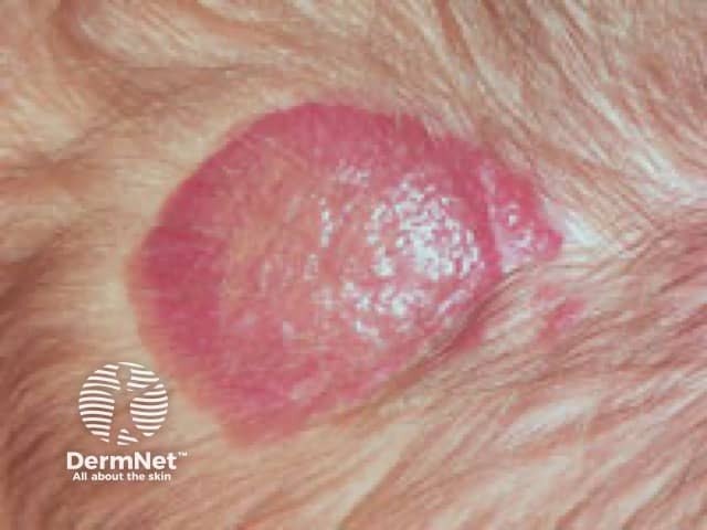 Superficial infantile haemangioma on the scalp