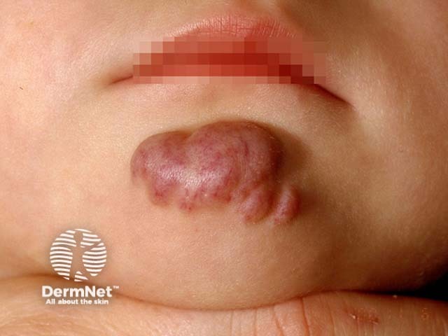 infantile-hemangioma image from DermNet