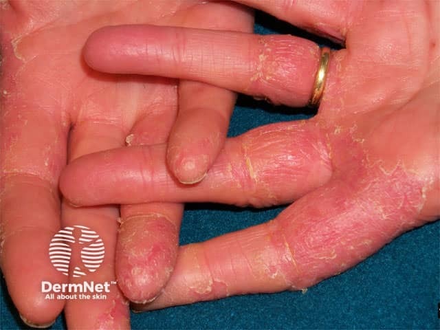 irritant-contact-dermatitis image from DermNet