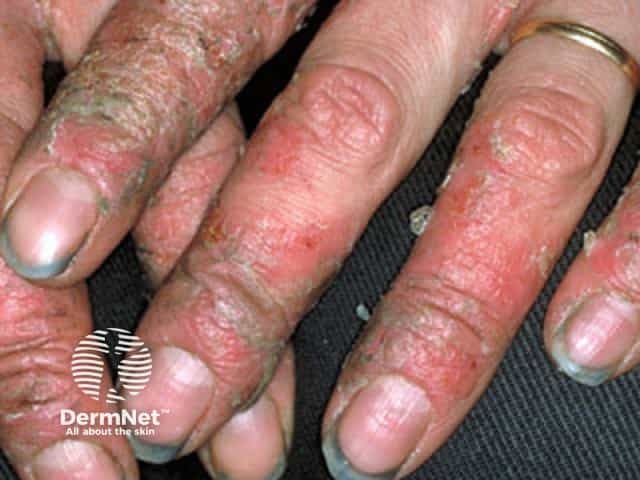 irritant-contact-dermatitis image from DermNet