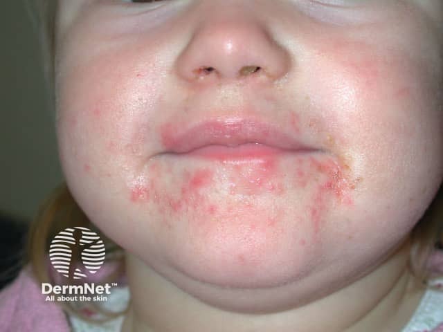 irritant-contact-dermatitis image from DermNet
