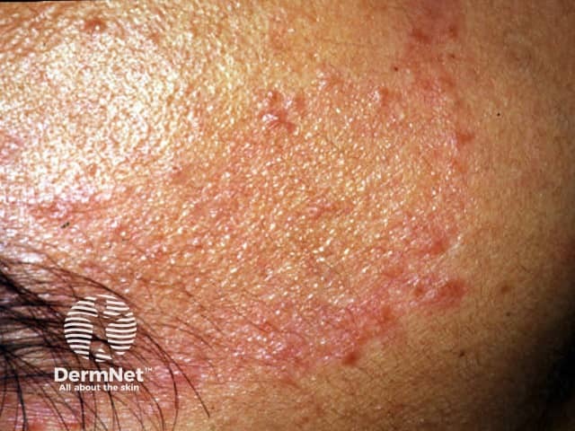 leprosy image from DermNet