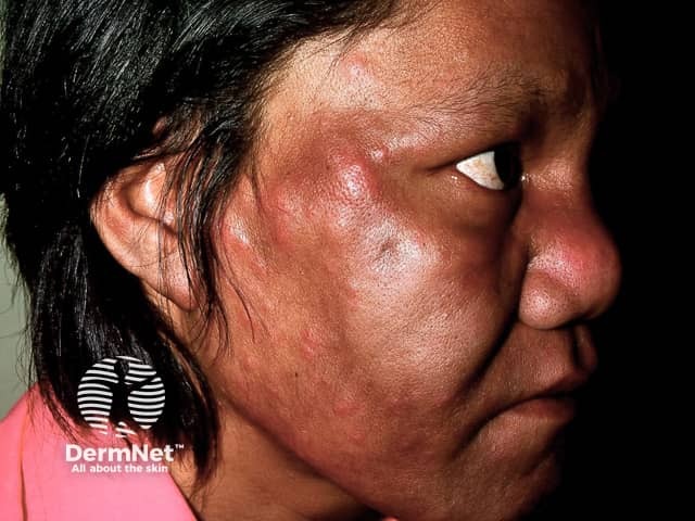 leprosy image from DermNet