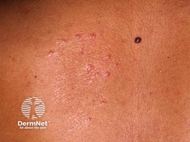 leprosy image from DermNet