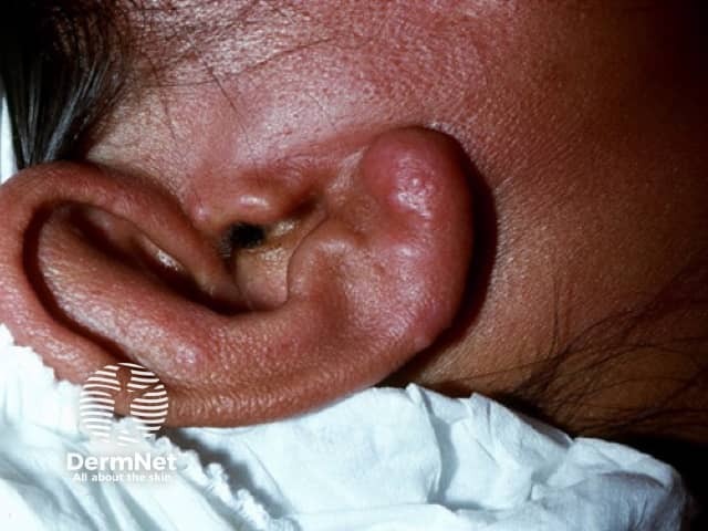 leprosy image from DermNet