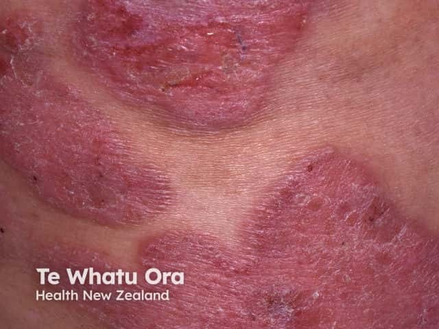 mycosis-fungoides image from DermNet