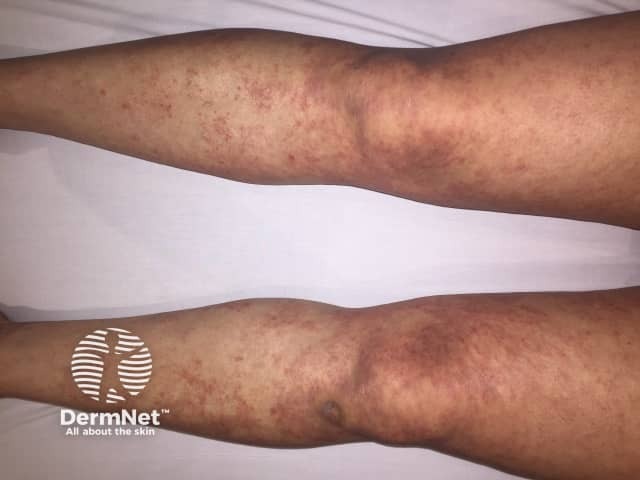 Folliculotropic mycosis fungoides