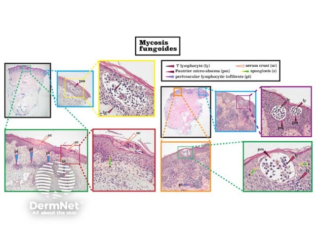 Mycosis fungoides histology