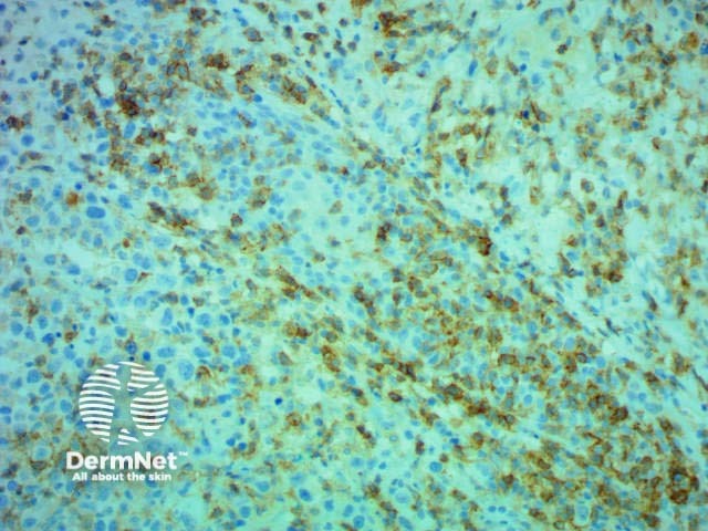 Immunohistochemistry CD4 stain positive