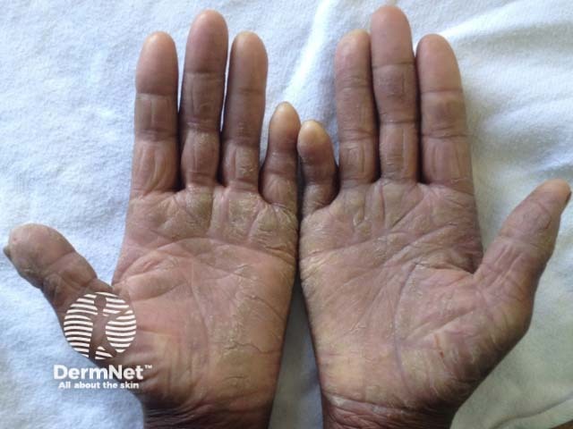 Mycosis fungoides palmaris